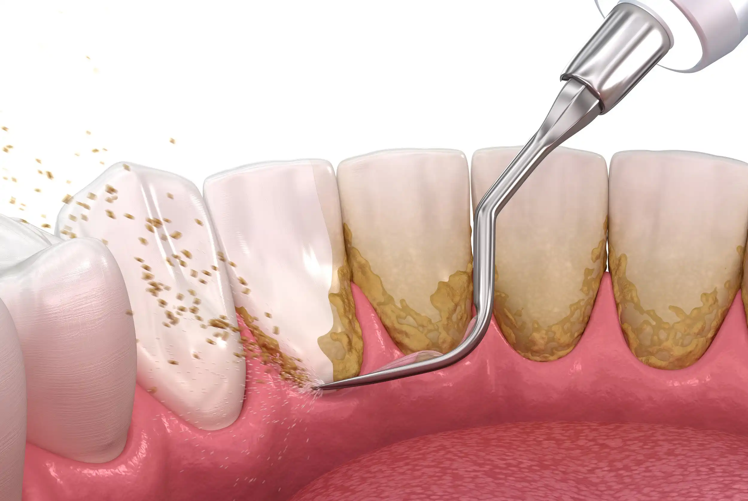 Teeth Cleaning (Scaling)
