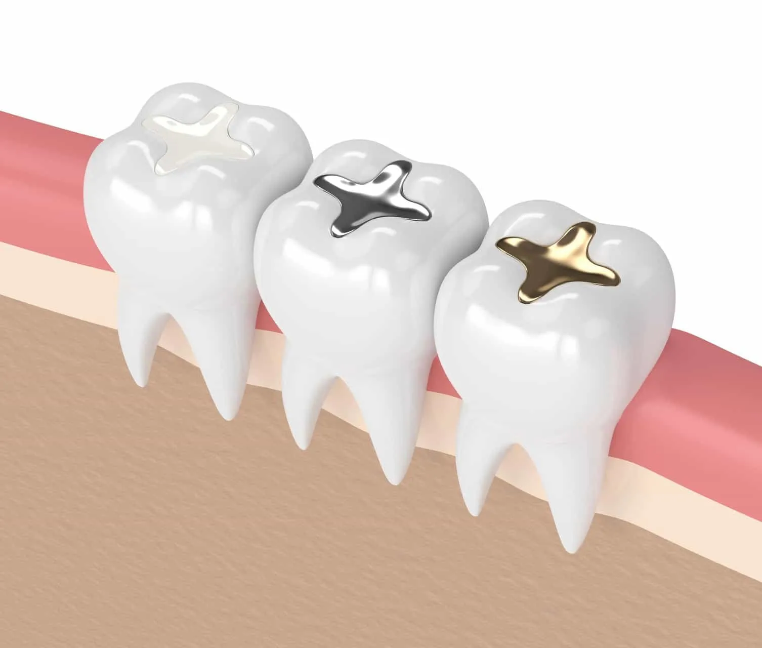 Tooth Filling