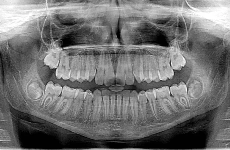 Dental X-Ray